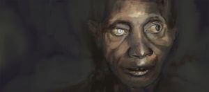 Medical Artwork that shows the River Blindness disease. The initial source is pharma.bayer.com (N/D). &quot;River Blindness&quot; retrieved on 01-01-2020 from https://pharma.bayer.com/river-blindness