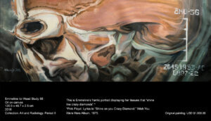 This is Emmeline’s frantic portrait displaying her atrophic tissues that “shine like crazy diamonds”.* *Pink Floyd. Lyrics to “Shine on you Crazy Diamond.” Wish You Were Here Album, 1975. This is Emmeline’s frantic portrait displaying her tissues that “shine like crazy diamonds”.* *Pink Floyd. Lyrics to “Shine on you Crazy Diamond.” Wish You Were Here Album, 1975.